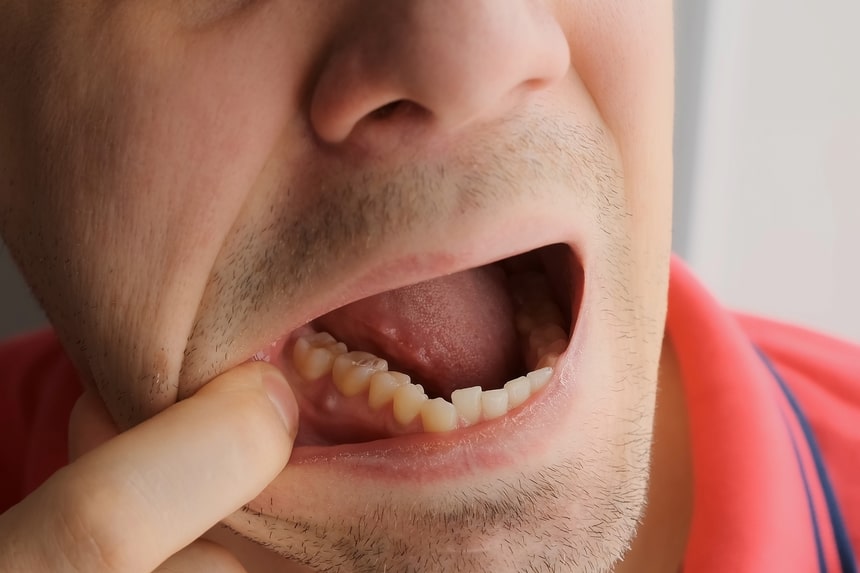 абсцесс зуба у мужчины