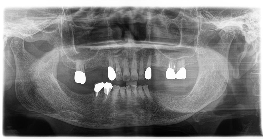 Атрофия (убыль) челюстной кости из-за отсутствия зубов