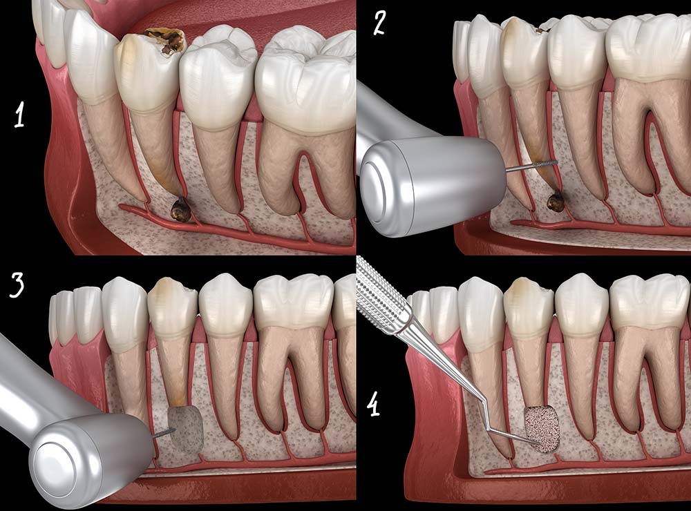Цистэктомия – операция по удалению крупной кисты зуба