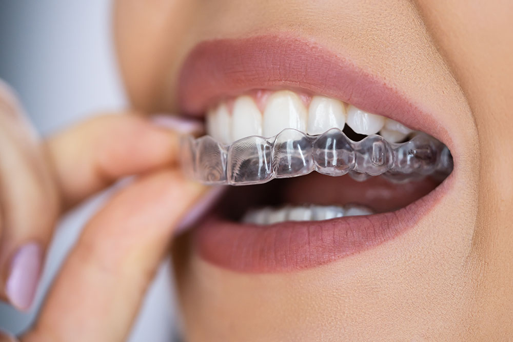Элайнеры – прозрачные капы для выравнивания зубов