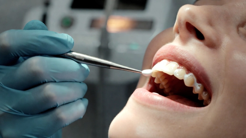Нанесение состава со фтором на зубы