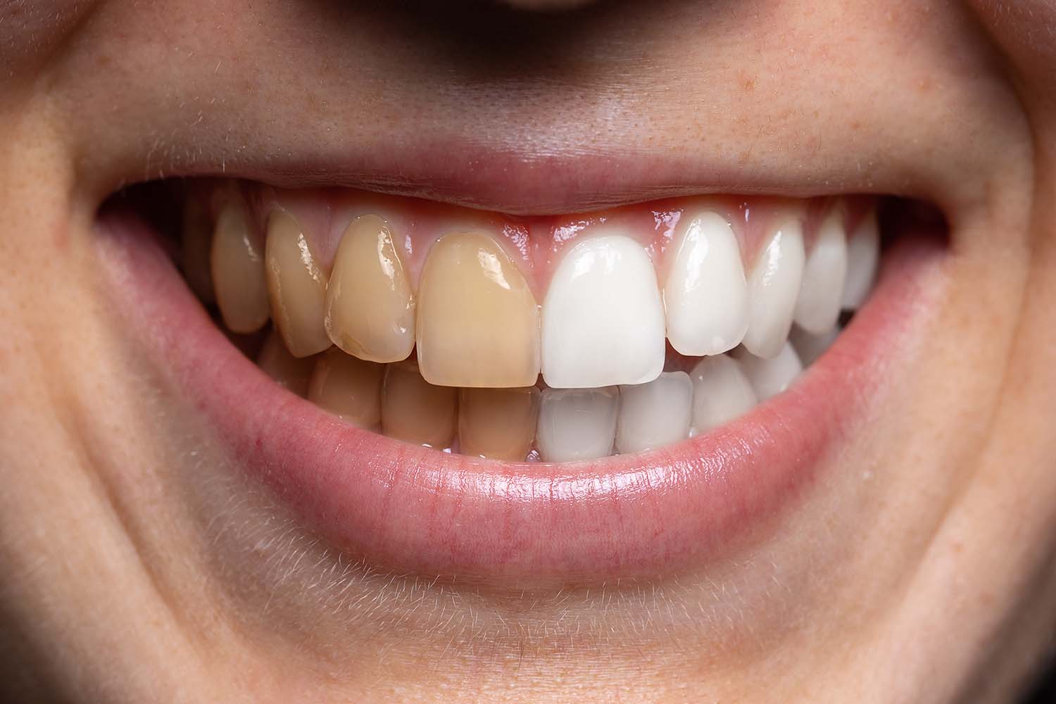 Гигиеническая чистка зубов – до / после
