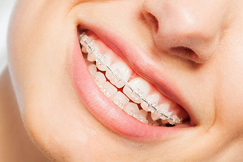 Керамические брекеты практически не видны на зубах