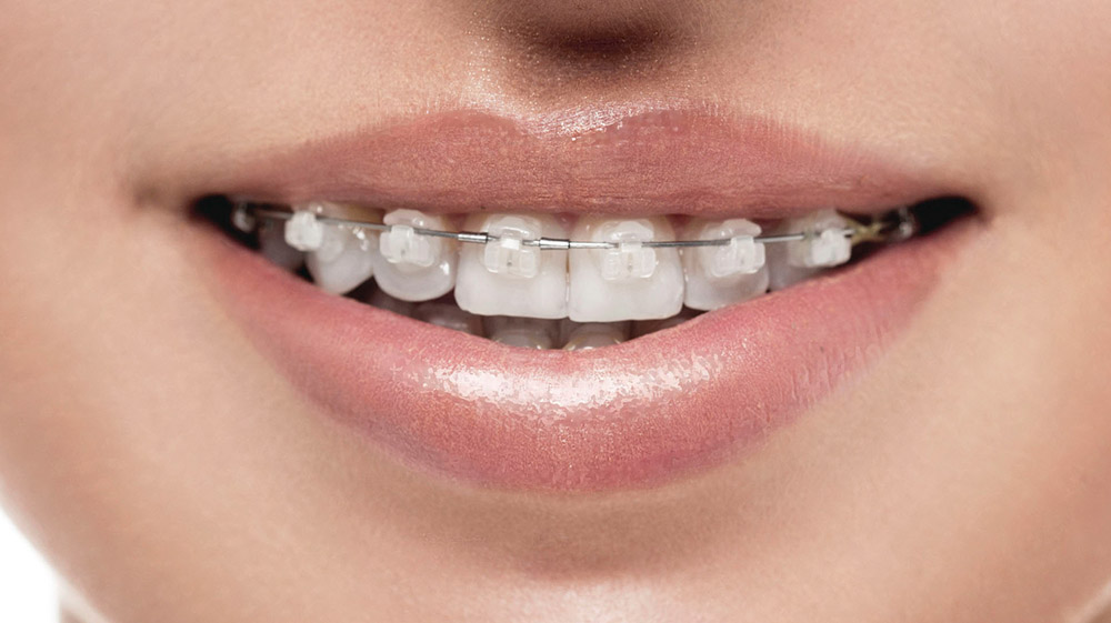 Керамические самолигирующие брекеты на зубах