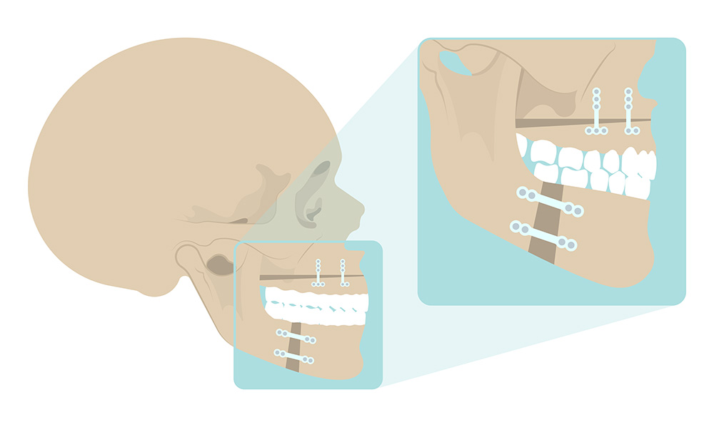 Схема хирургической коррекции челюсти