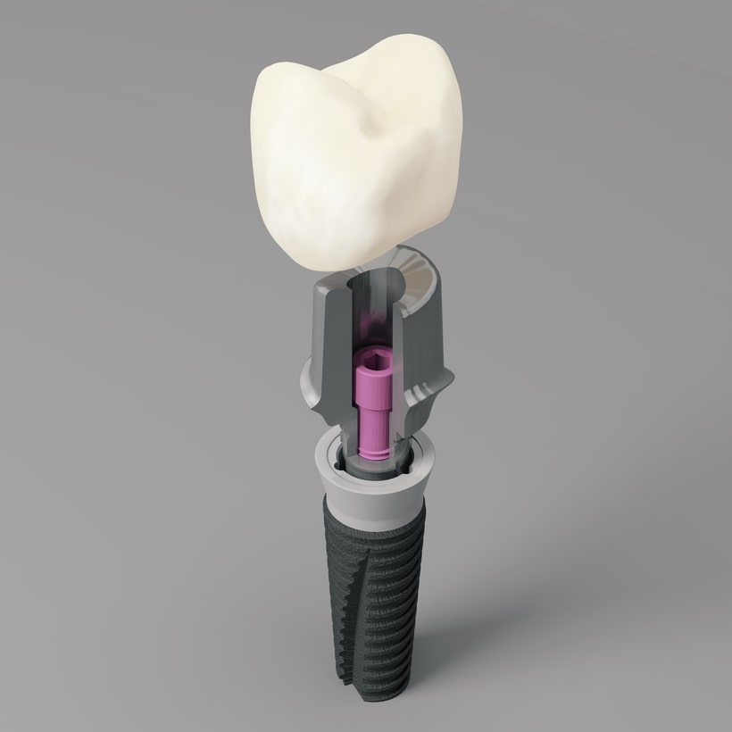 3D модель зубного импланта
