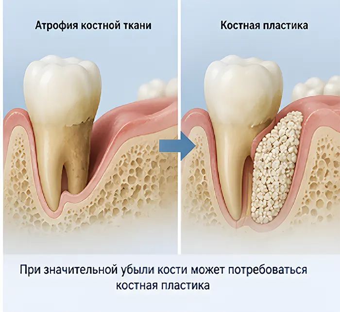 Дентальные импланты надёжно фиксируются в костной ткани