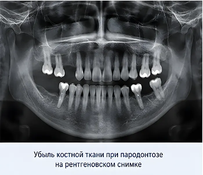 Убыль костной ткани при пародонтозе на рентгеновском снимке