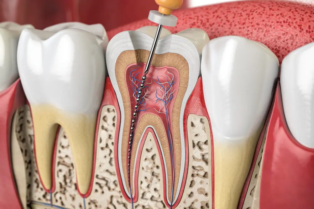 Некачественно лечение корневого канала - наиболее распространенная причина болей под зубной коронкой