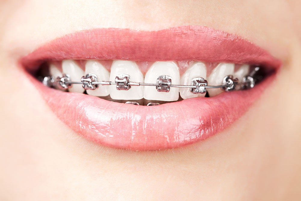 Металлическая самолигирующая брекет-система на зубах