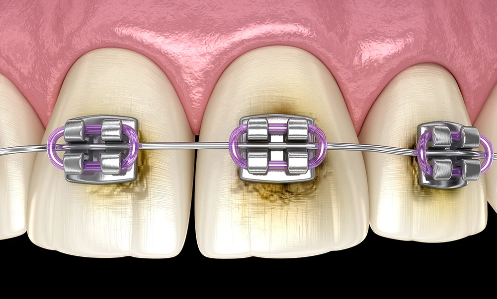 Налёт и деминерализация эмали вокруг брекетов