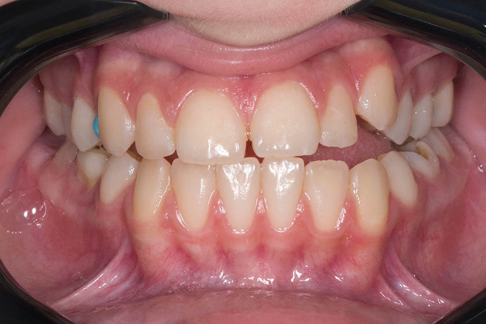 Односторонний боковой дефект прикуса – зубы не соприкасаются только с левой стороны