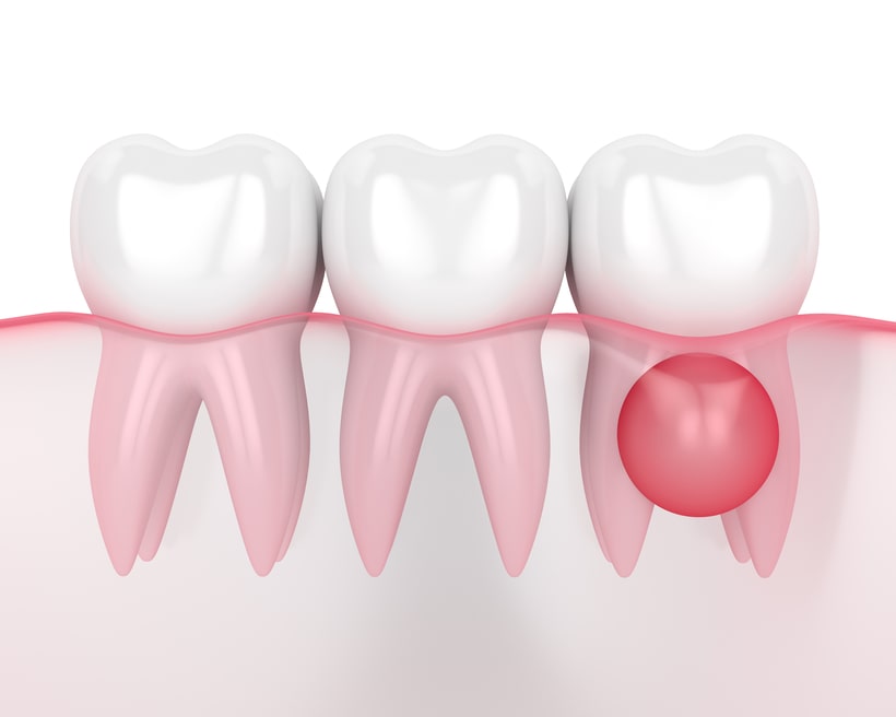 Показания для удаления восьмых зубов