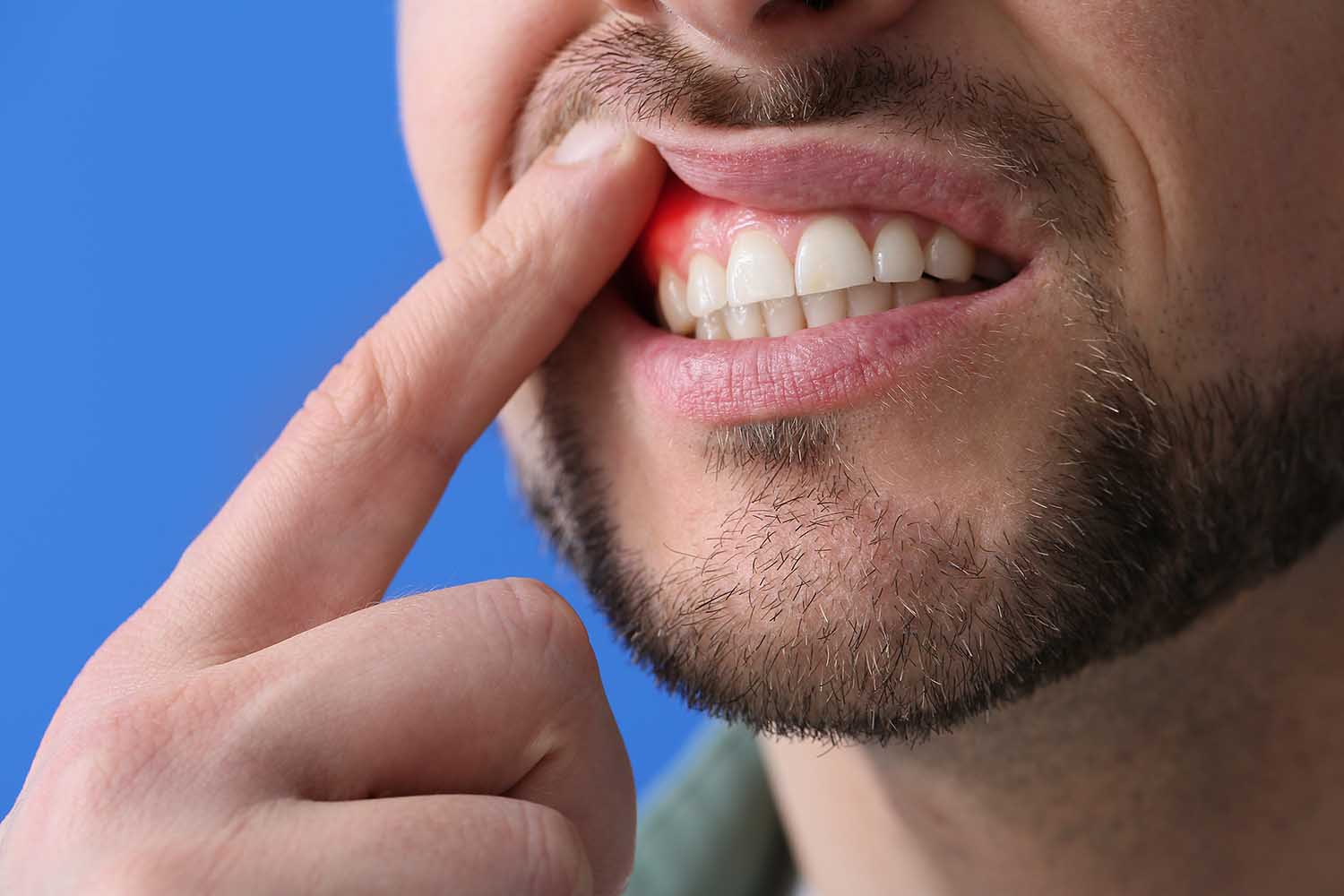 Периостит зуба после перфорации гайморовой пазухи