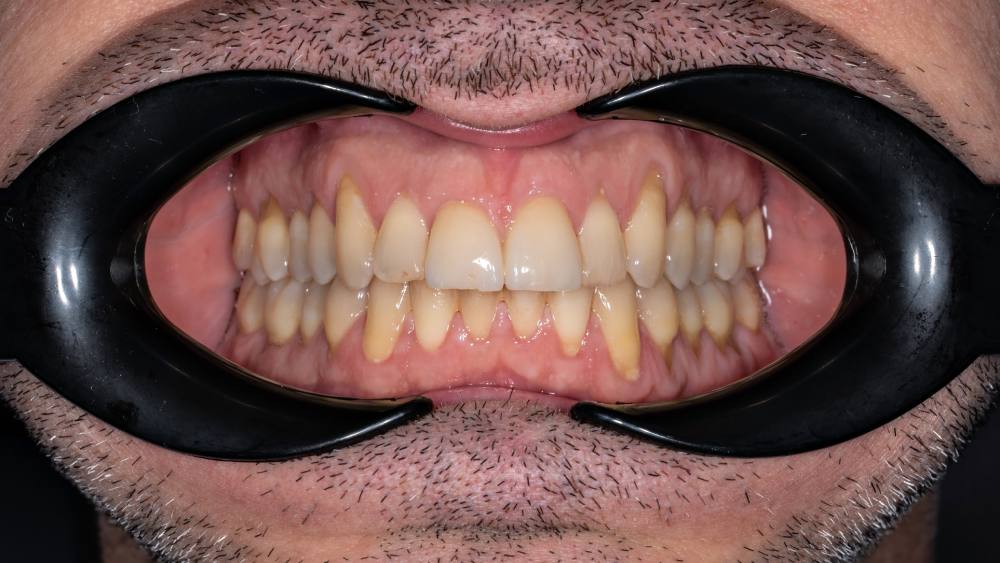 Пигментированный налет на зубах