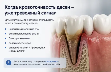 Когда кровоточивость дёсен – тревожный сигнал