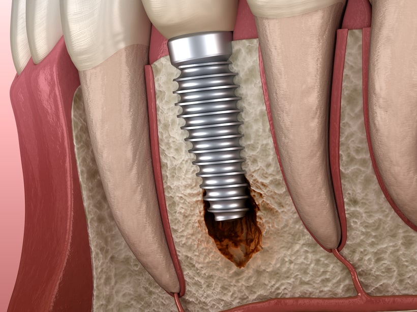 Заболевание костной ткани в области зубного импланта