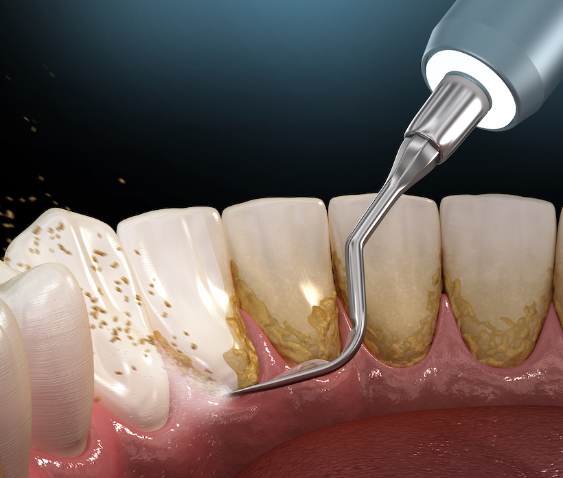Рекомендации стоматолога после чистки зубов от камня