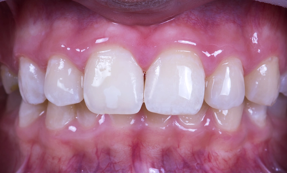 Зубы после реминерализации