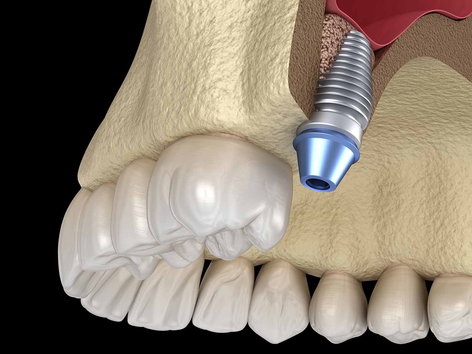 Корень зуба в гайморовой пазухе - цена операции по удалению