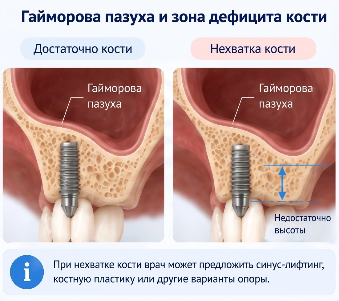 Схема имплантации зуба при достаточной и недостаточной высоте кости