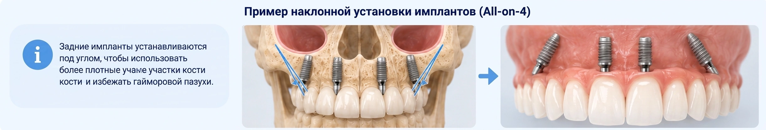 Схема наклонной установки имплантов по методике All-on-4