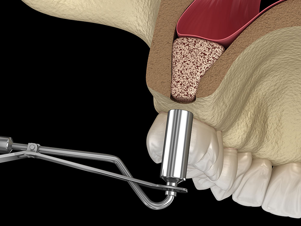 Синус-лифтинг перед имплантацией – операция по поднятию дна гайморовой пазухи