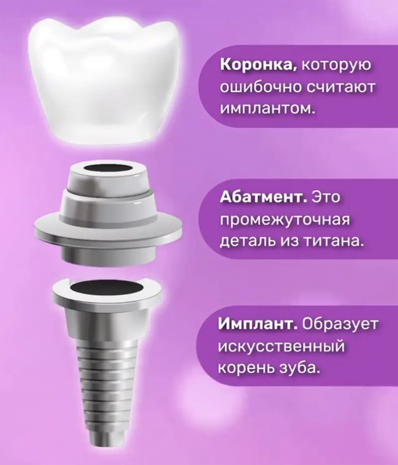 Схематичное фото зубного импланта с коронкой