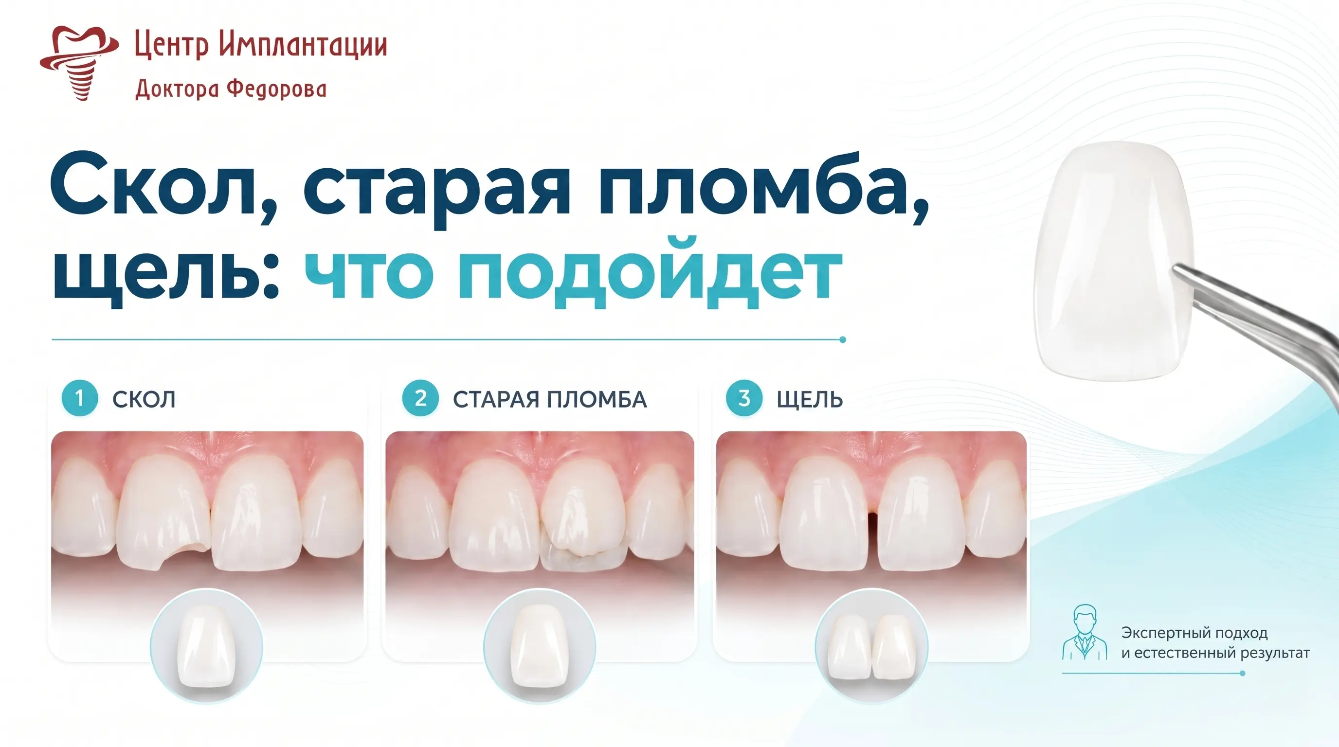 Инфографика: скол, старая пломба, щель - что подойдет