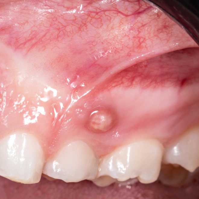 Свищ на десне