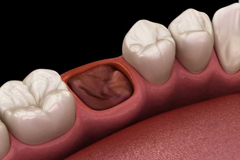 Почему после удаления зуба возникают боли и как их облегчить