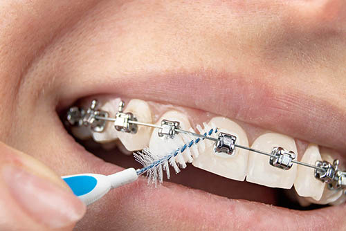 Лингвальные брекеты крепятся к внутренней поверхности зубов
