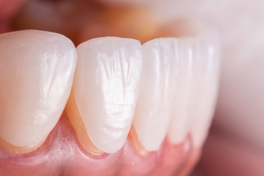 Установка виниров на передние зубы в зоне улыбки
