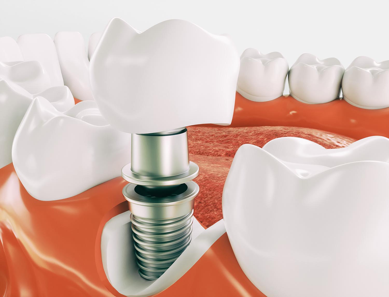 В челюстную кость установлен имплант зуба