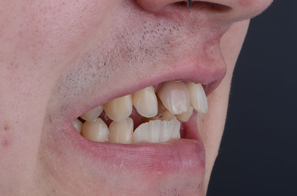 Верхние зубы очень выдвинуты вперед, из-за этого между верхней и нижней челюстью есть пространство