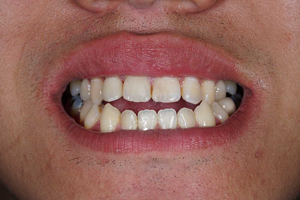 Верхний зубной ряд не перекрывает нижний