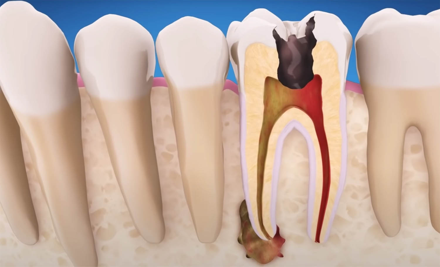 Воспаление у корня зуба