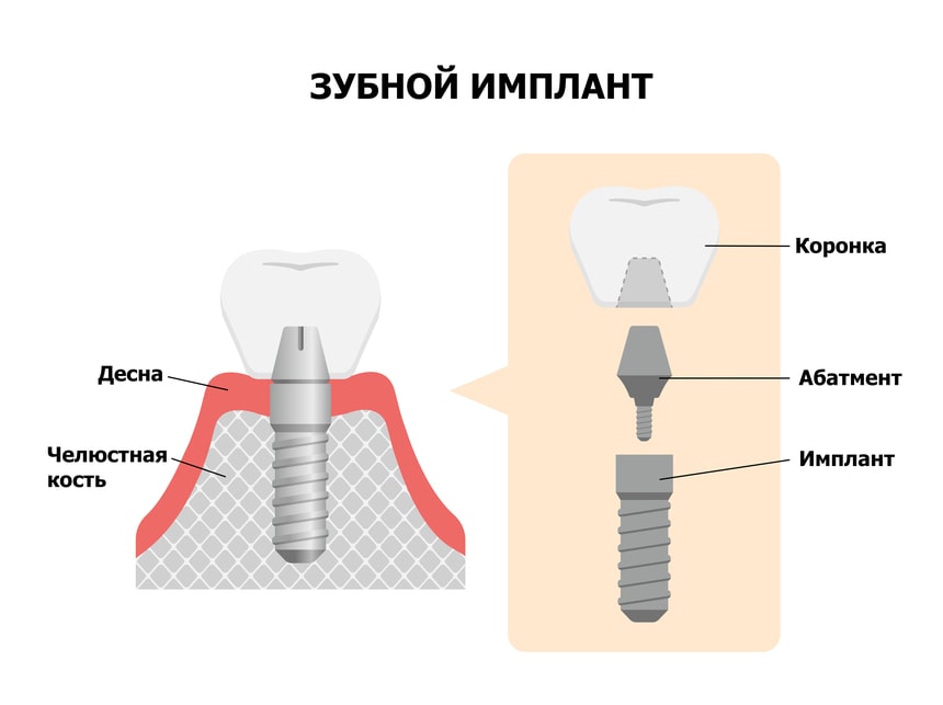 зубной имлпант в собранном и разобранном виде