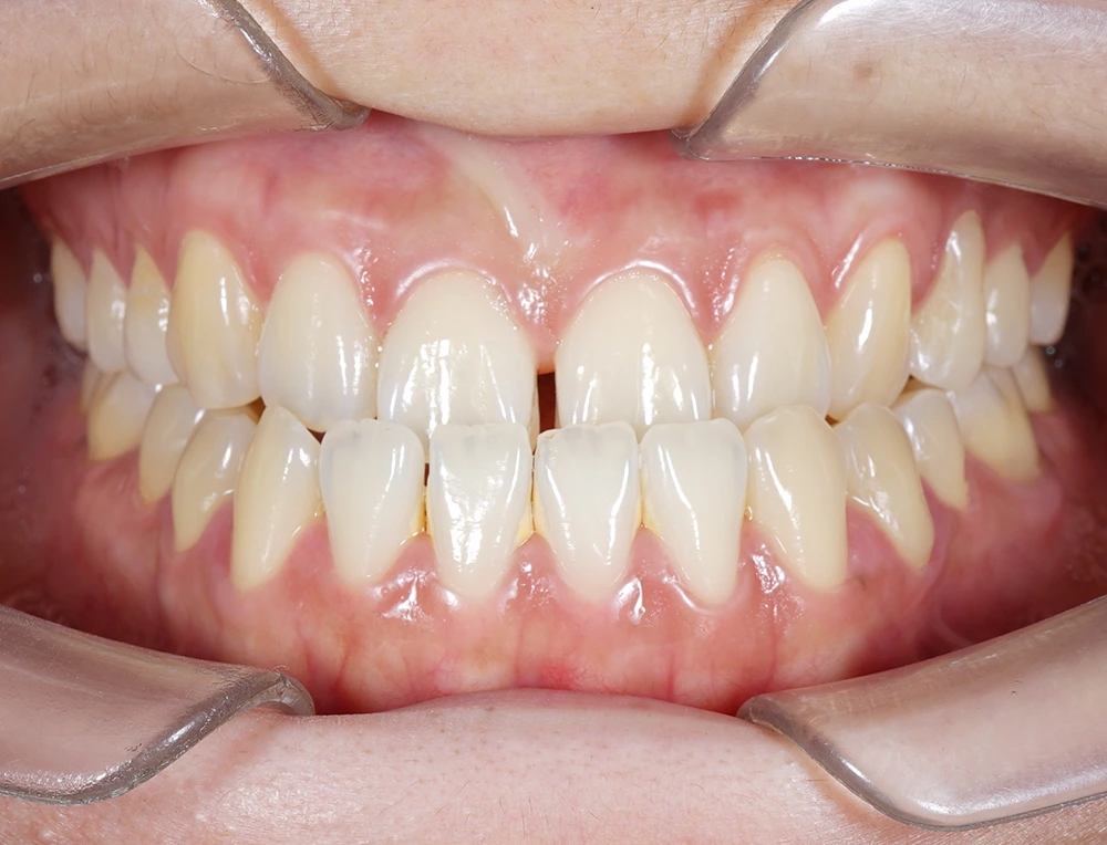 Пять зубов верхней челюсти расположены за нижними зубами