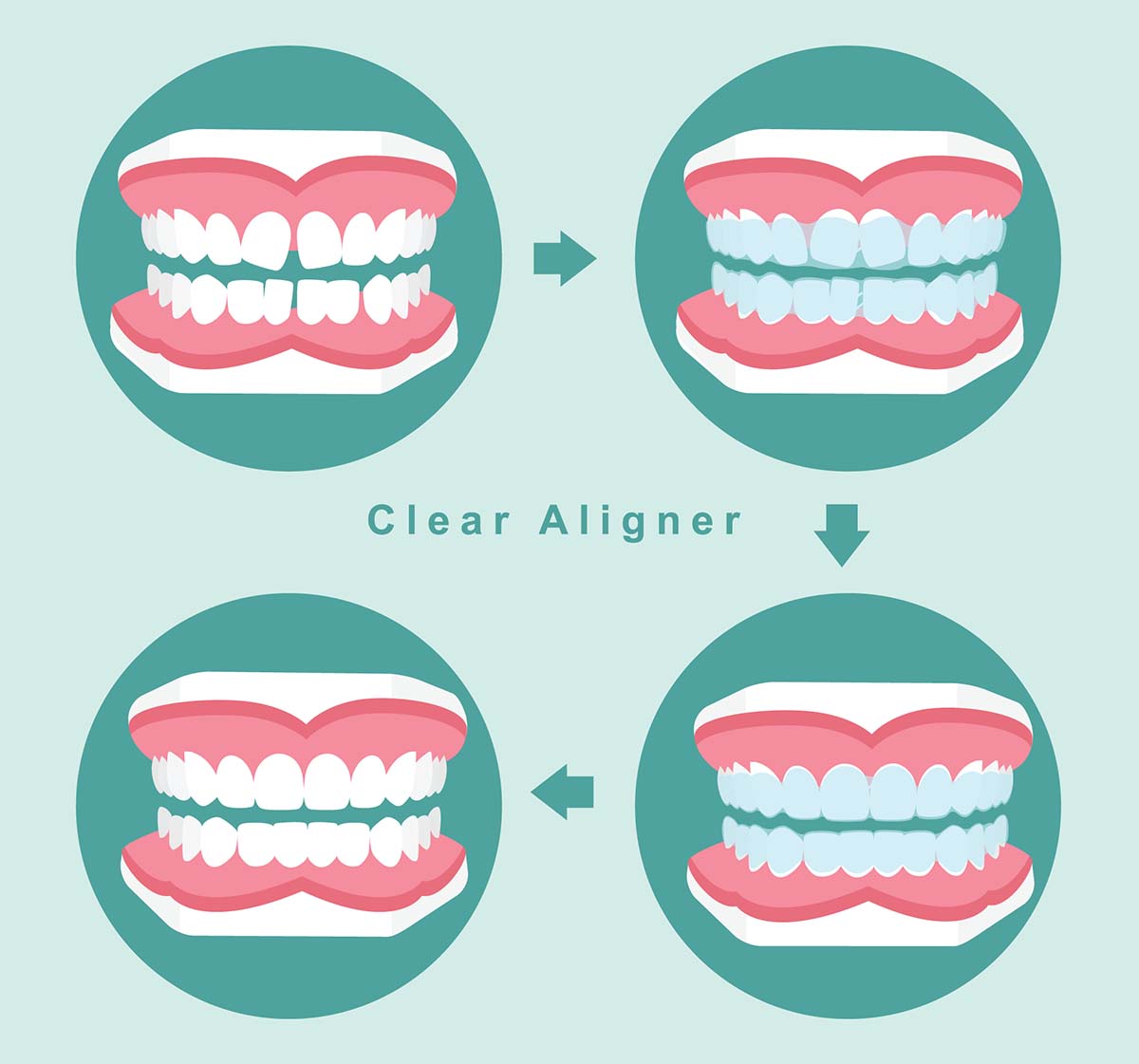 Элайнеры постепенно выравнивают зубы