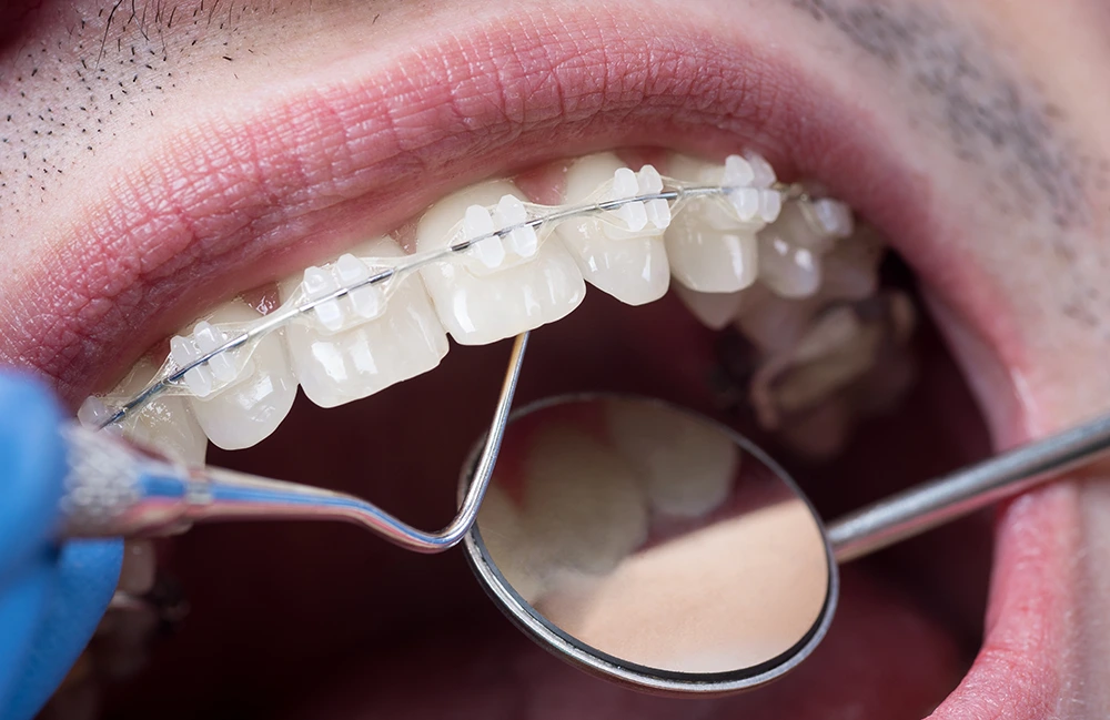 Стоматолог осматривает полость рта у пациента с керамическими брекетами