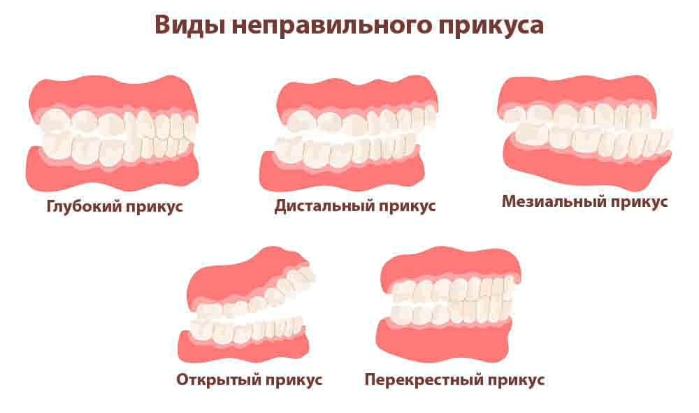 Виды неправильного прикуса
