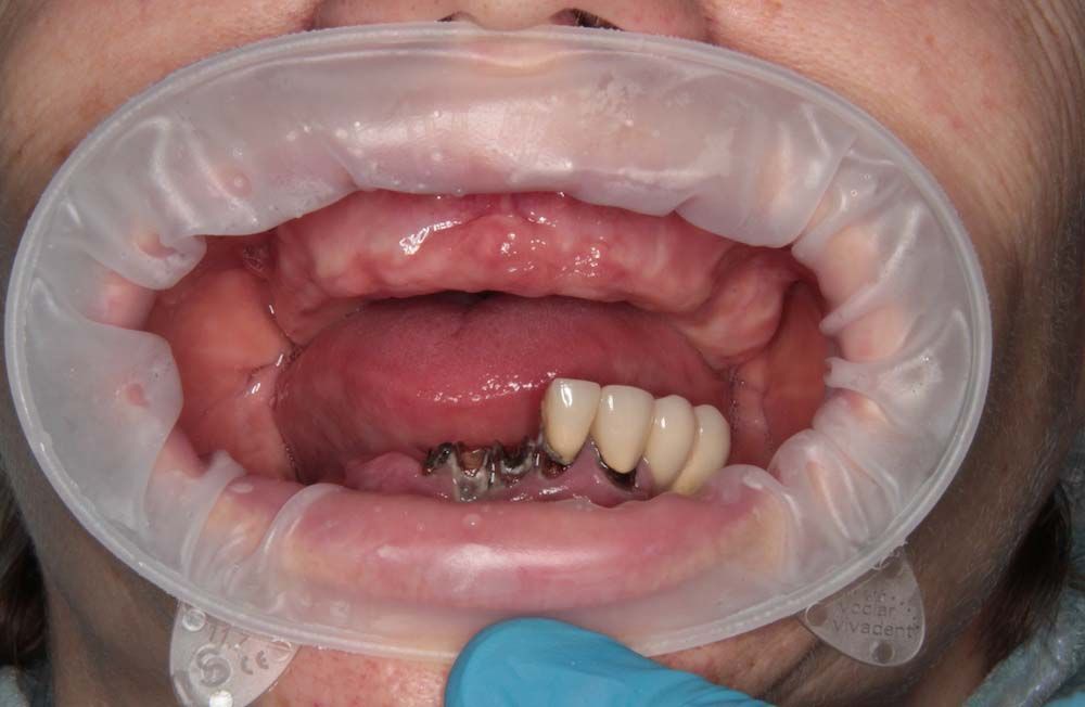 Отсутствие зубов верхней и нижней челюстей