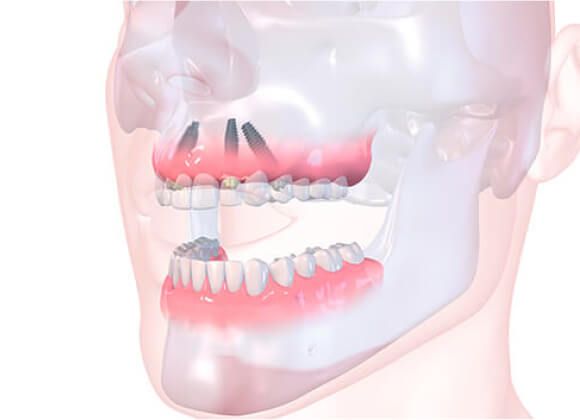 Имплантация зубов All-on-4 за 1 день