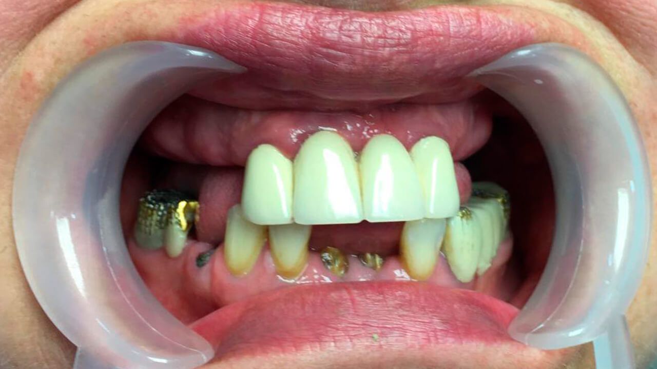 Отсутствие передних зубов, эстетический дефект