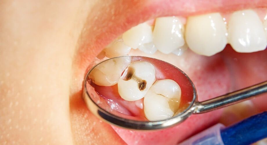 Лечение зуба с пломбировкой канала