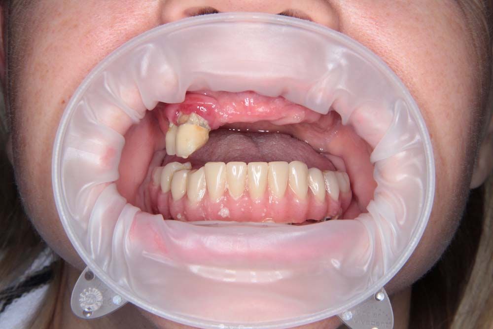 Отсутствие зубов и нарушение жевательной функции верхней челюсти