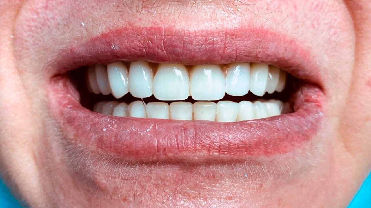 Установлены зубы для обеих челюстей по методике All-on-6