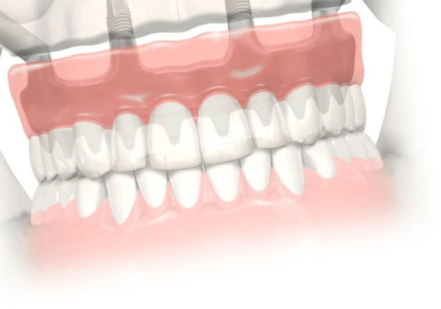 Имплантация челюсти на 4 имплантах. All on 4 металлопластмасса. All on 4 имплантация клиника Starlight.