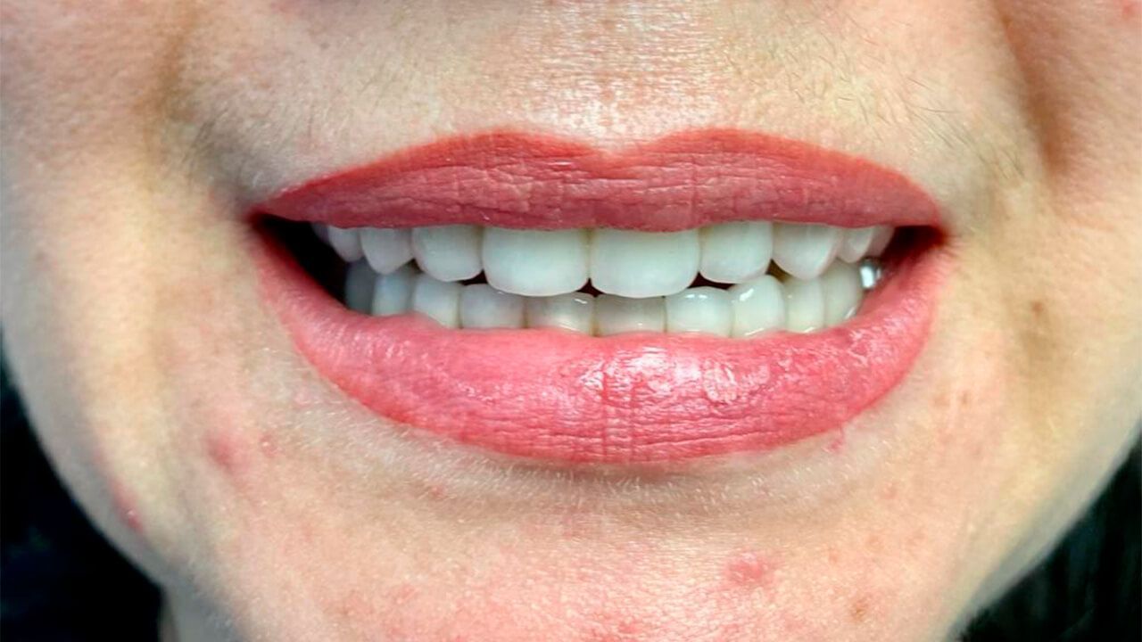 Удаление оставшихся зубов и протезирование методом All-on-6